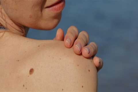 Melanoma: Causes, Symptoms, Diagnosis, Treatment, and Prevention