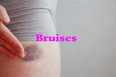 10 Home Remedies for Bruising - Home Remedies App