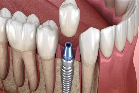 Replacing Missing Teeth: Tooth Extraction And Dental Implants In Austin, TX