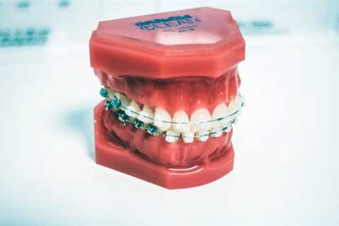 Step by Step: A Look Into the Process of Braces