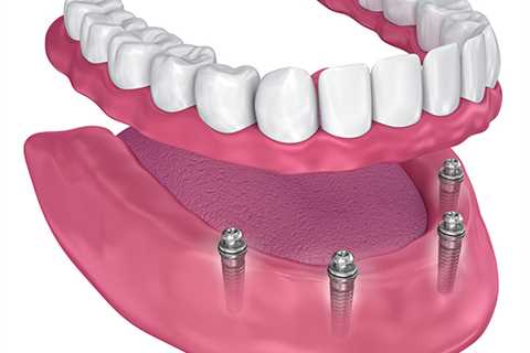 Revitalize your smile with Richter Dental's superior implants. Trusted experts in tooth..
