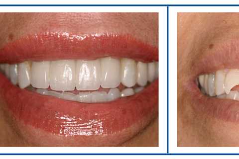 How much is a full set of top veneers?