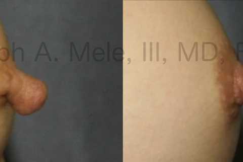 Inverted Nipple Repair and Nipple Reduction Surgery