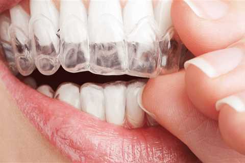 Is Invisalign a Good Option for Kids? - An Expert's Perspective