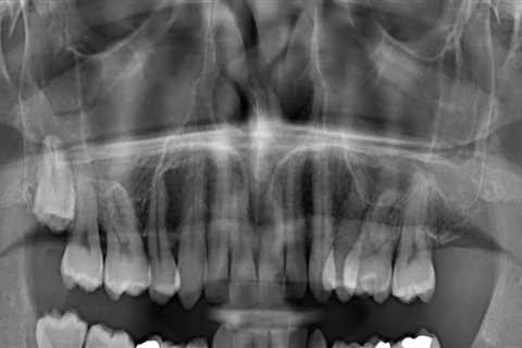 Are frequent dental xrays harmful?