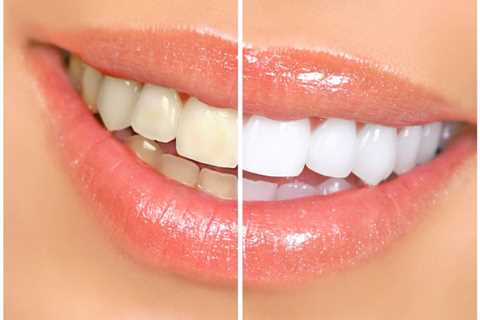 5 Must-Know Cosmetic Dentistry Procedures
