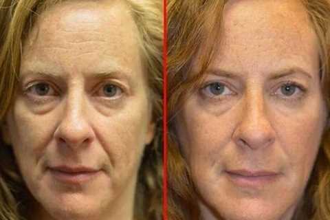 How Long Is Botox Good For After Reconstitution
