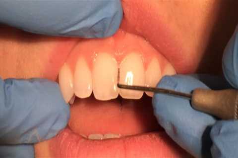 Exploring the Use of Dental Probes in Dentistry