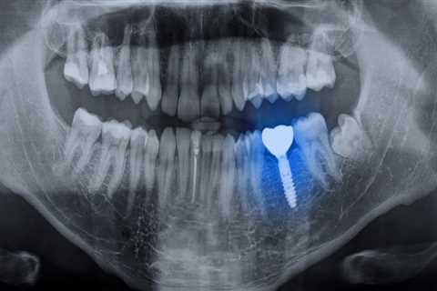 Do Dental Implants Require Regular X-Rays After Placement?