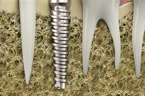 Are Dental Implants the Right Choice for Everyone?
