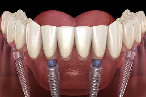 How Many Implants Do You Need for a Full Set of Teeth?