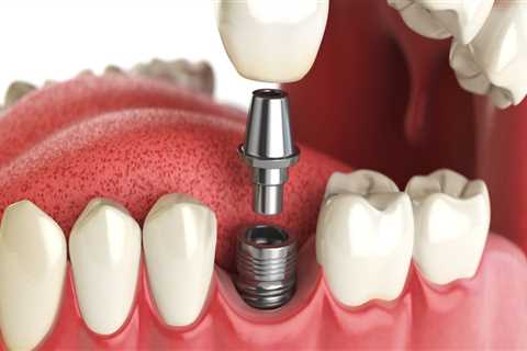 Can I Get a Crown with a Single Dental Implant?