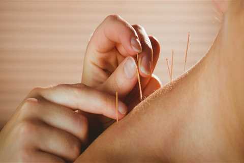 The Risks and Benefits of Acupuncture