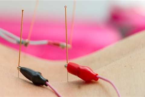 What is Electroacupuncture and How Does it Differ from Traditional Acupuncture?
