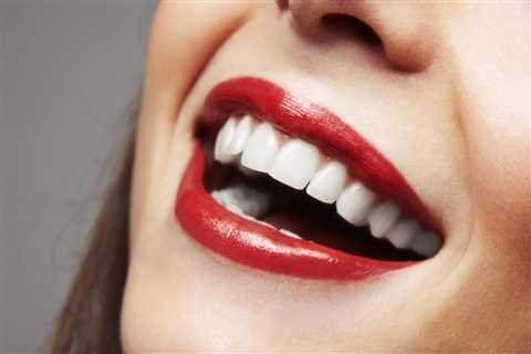 How Veneers Can Improve the Appearance of Your Smile