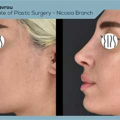 Standard post published to Dr. Demetris Stavrou - European Institute of Plastic Surgery - Nicosia..