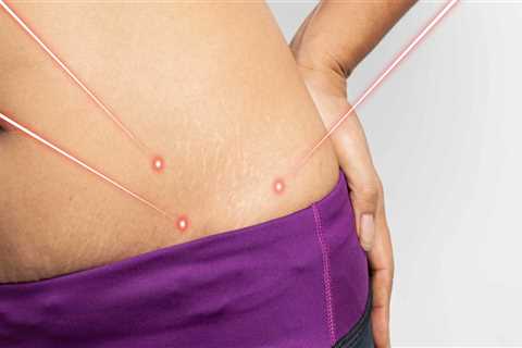 Can laser lipo cause weight gain?