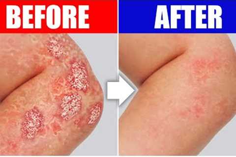 The #1 Remedy for Psoriasis