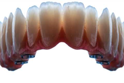 All-On-Four Dentures: A Game-Changer In Pediatric Dentistry In Gainesville