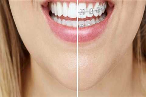 Straighten Your Teeth In Style With Invisalign: Meet Your Sydney Invisalign Dentist