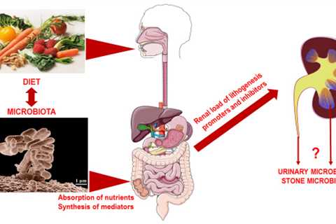 Alkaline Water and Reduced Risk of Acid-Related Urinary Stones