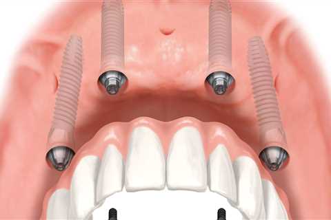 Transforming Smiles In Pflugerville, TX: How Invisalign Works Together With All-On-Four Dentures..