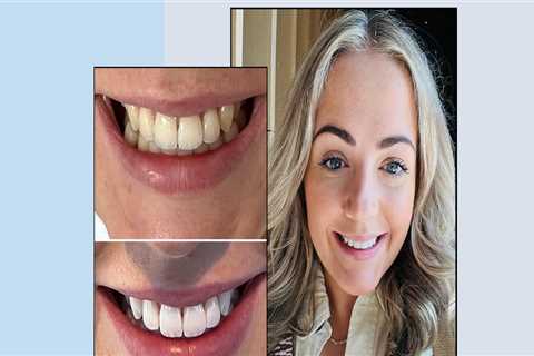 Smile Makeover vs Teeth Whitening: What's the Difference?