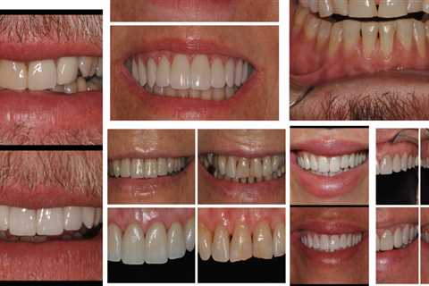 How Long Will the Results of a Smile Makeover Last?