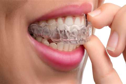 How Long Does It Take to Achieve a Perfect Smile with Invisalign Treatment?
