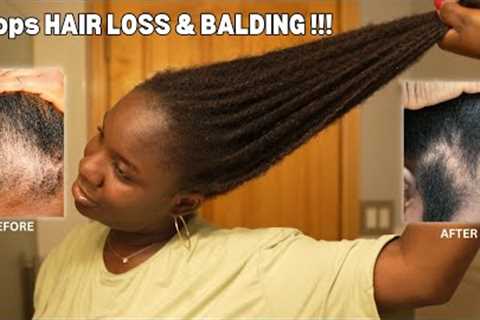 Use This Once a Week and Your Hair Will Never Stop Growing| DIY for HAIR LOSS & BALDING‼️
