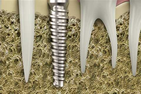 Teeth Implants On Main Street: A Comprehensive Guide To Dental Implant Advancements