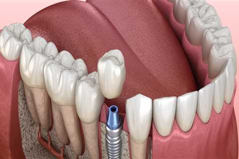 Why Are Dental Implants The Most Effective Treatment In Boerne For Tooth Loss And Damage