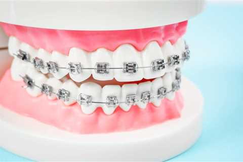 The Cost of Braces: Is It Worth the Investment?
