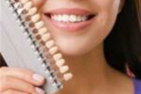 Dental veneers patients