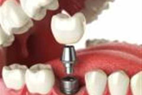 Dental crown patients