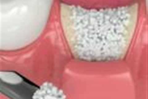 Bone grafting patients