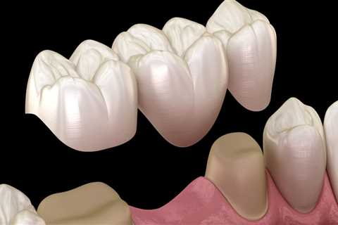 Experience The Transformation: Dental Implants In Spring Branch