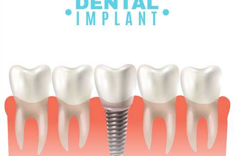 Шүдний Имплант гэж юу вэ? - PRODENT