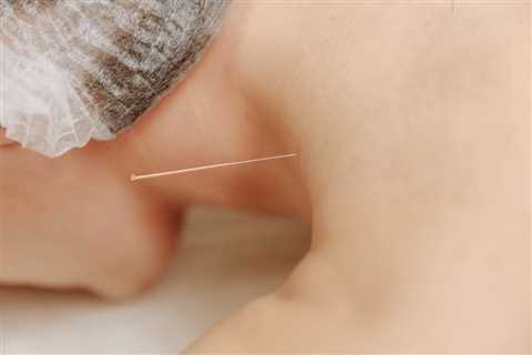 THE BENEFITS OF ACUPUNCTURE FOR DEPRESSION AND ANXIETY | Bankruptcy Attorney Orem
