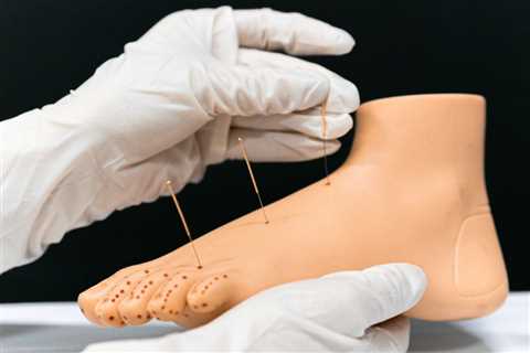 HOW TO USE ACUPUNCTURE FOR FOOT PAIN RELIEF | Bankruptcy Attorney Orem