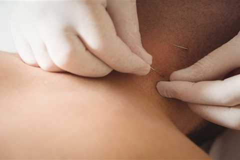 THE BENEFITS OF ACUPUNCTURE FOR CHRONIC PAIN IN POLYMYALGIA RHEUMATICA PATIENTS ON LOW-DOSE..