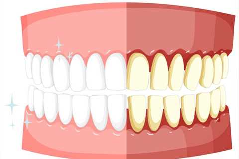 Шүдний чулууг арилгах шалгарсан 5 арга - PRODENT