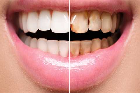 Do you still have feeling in your teeth with veneers?