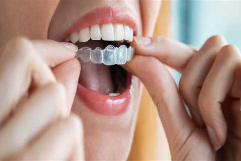 A Perfect Smile Starts Here: Finding The Right Invisalign Dentist In Taylor, Texas