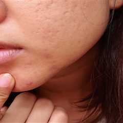 Winning the Battle Against Blackheads: Expert Tips and Treatments