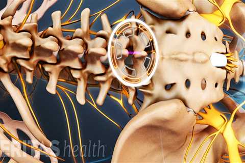 Is spinal decompression a major surgery?