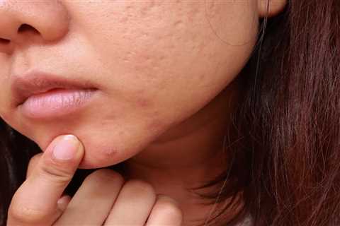 Winning the Battle Against Blackheads: Expert Tips and Treatments