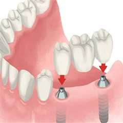 Are dental implants expensive?