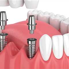 How are dental implants done step by step?