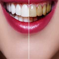 How much does a top row of veneers cost?